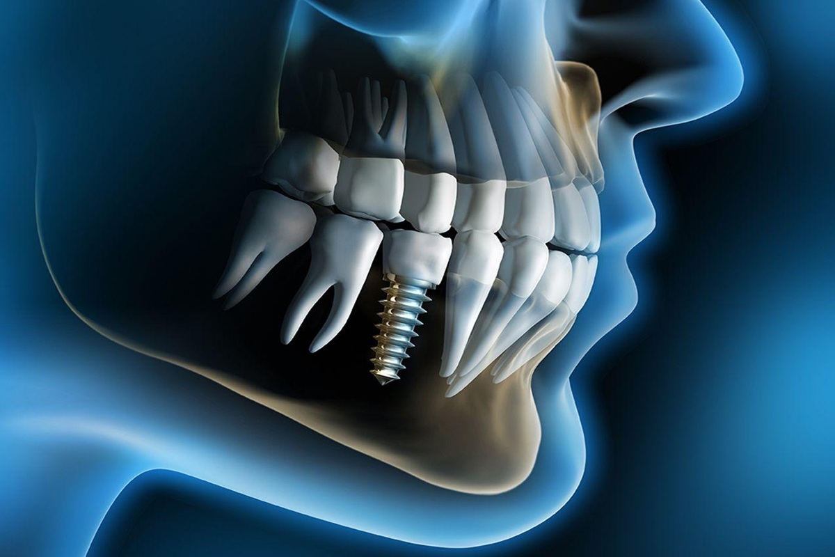 Best Dental Implant Treatment at Root Care Dental Clinic
